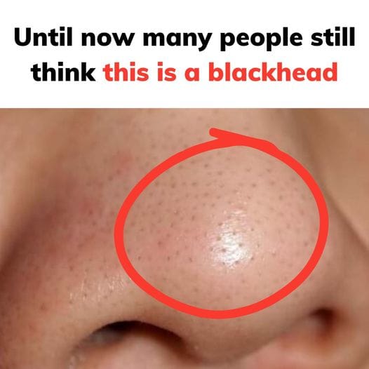 Until now many people still think this is a blackhead