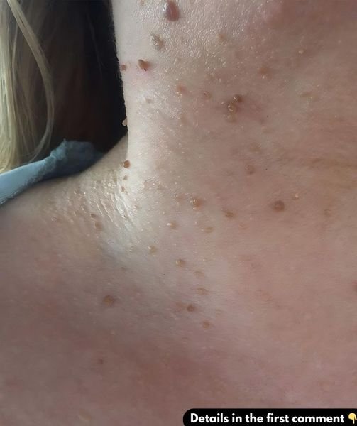 What are the best natural ways to remove moles from the skin?