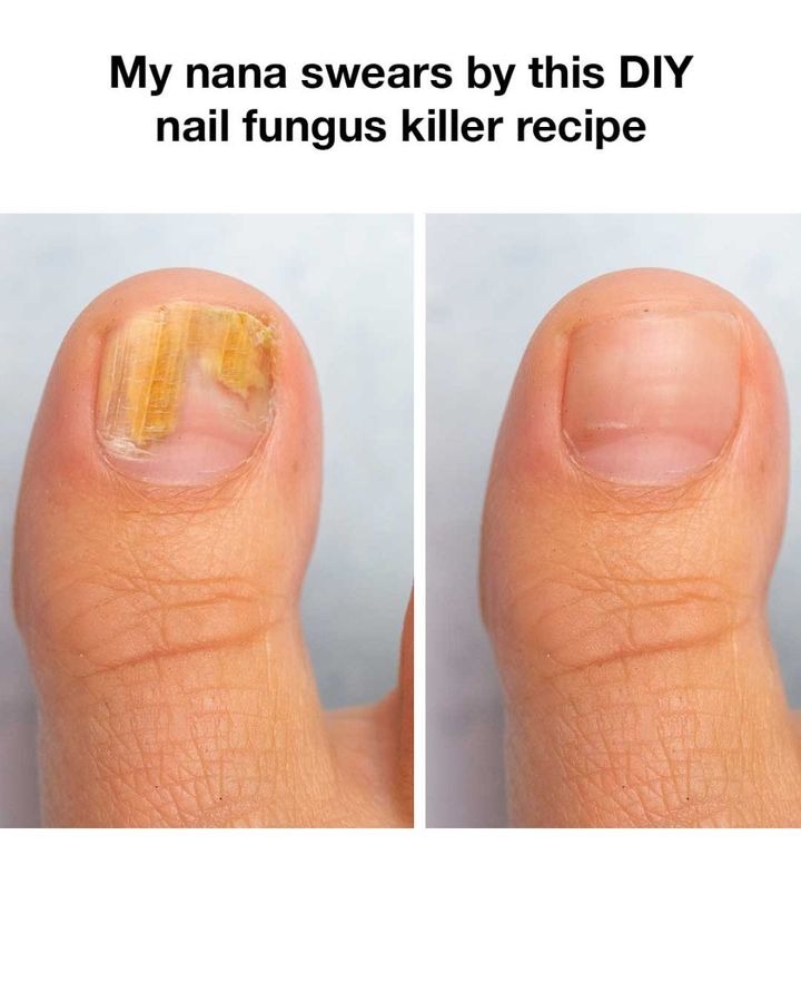 Nana has nail-fungus cure