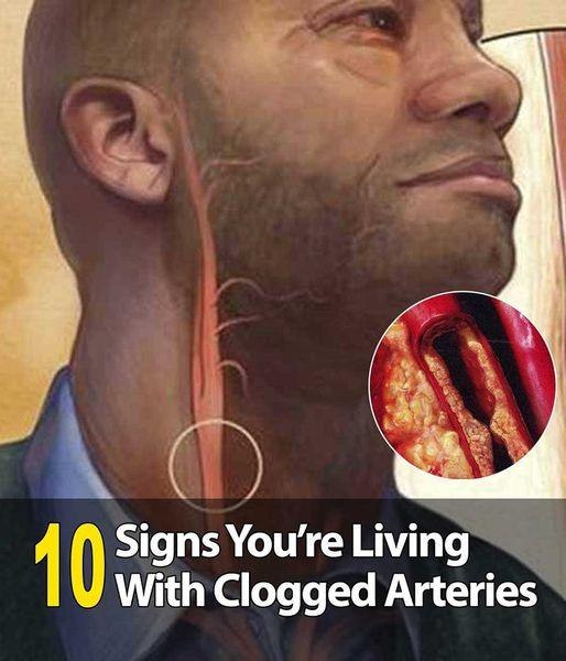 10 Signs You’re Living With Clogged Arteries