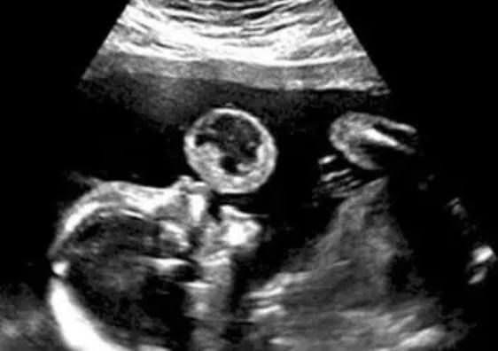 Mom Thinks Her Baby Is Blowing Bubble In Ultrasound, Then Doctors Discover What It Really Is