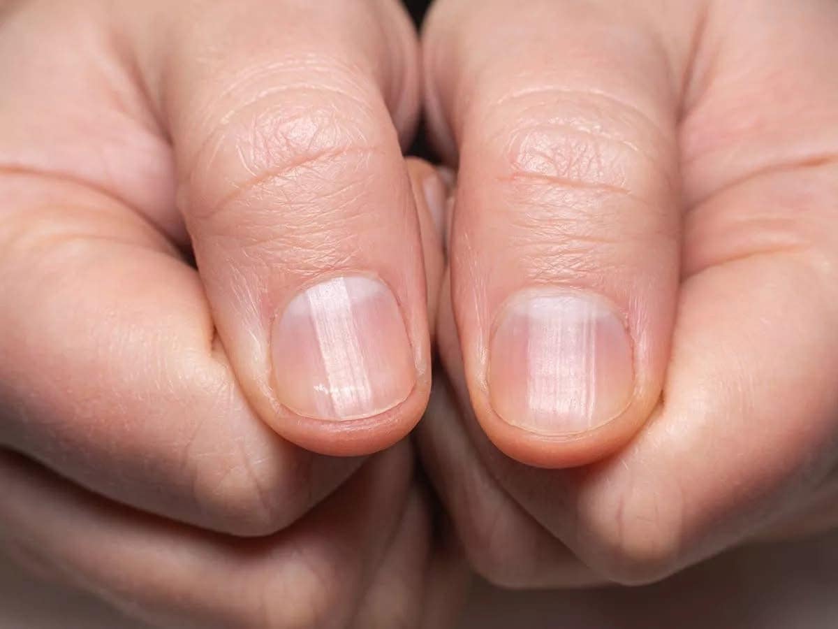 Doctor Explains What It Means If You Have Ridges On Your Fingernails