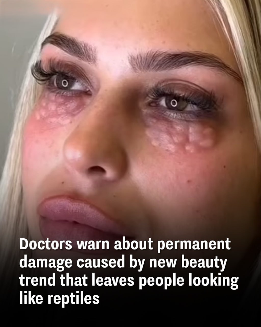 Doctors warn about permanent damage caused by new beauty trend that leaves people looking like reptiles