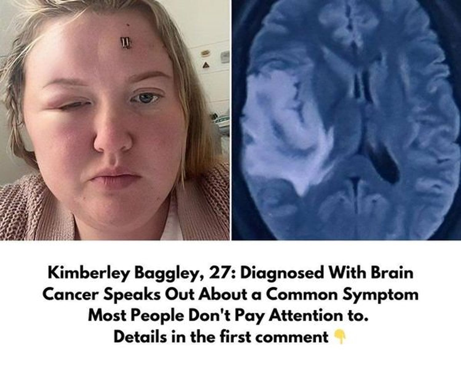 Kimberley Baggley, 27: Diagnosed With Brain Cancer Speaks Out About a Common Symptom Most People Don’t Pay Attention to. Details in the first comment 👇👇👇