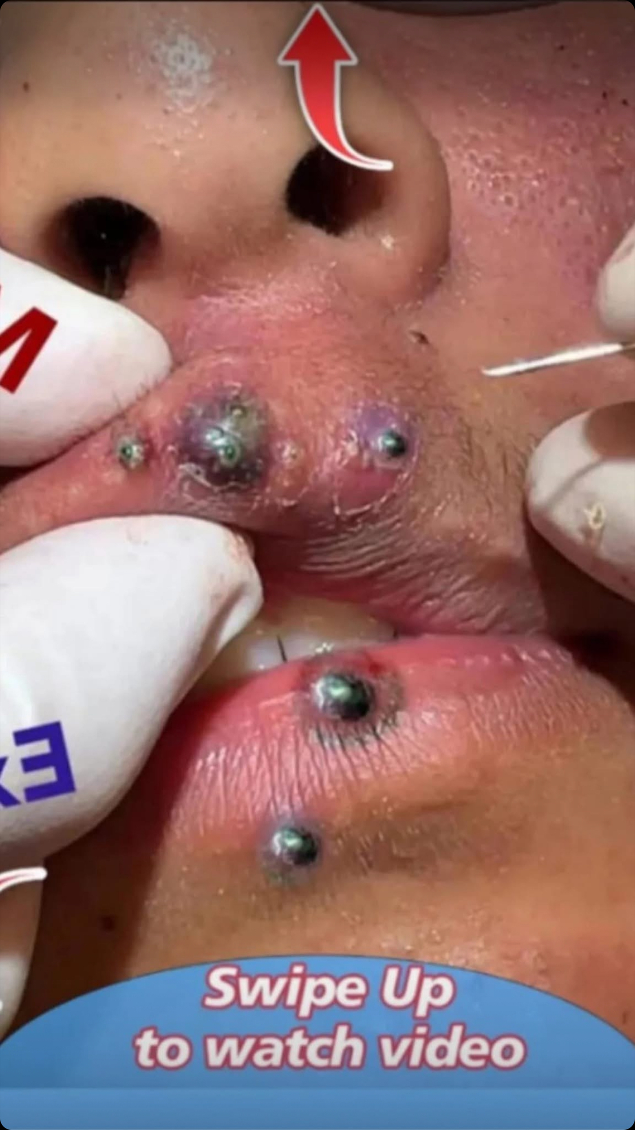 Big Cystic Acne Blackheads Extraction Blackheads & Milia, Whiteheads Removal Pimple Popping